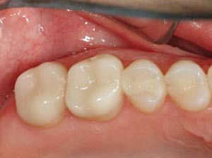 After CEREC crowns