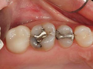 before CEREC crowns