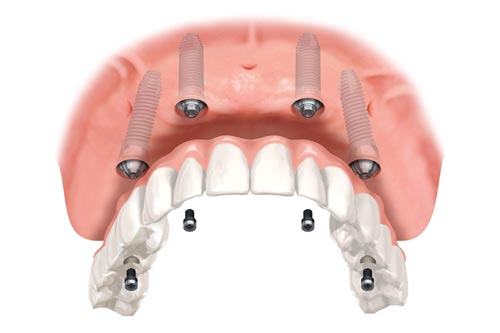Fixed Screw retained Complete Denture
