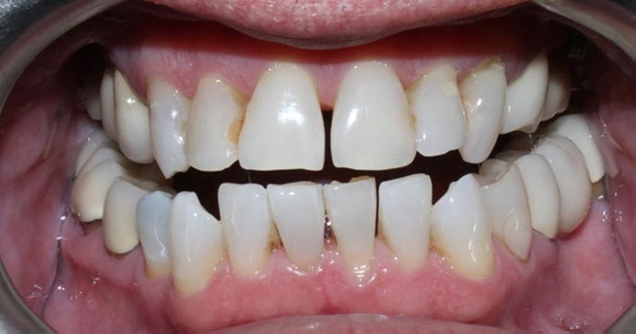 after GLO teeth whitening