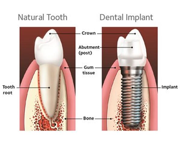 implants