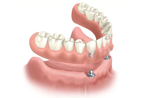  Locator Over dentures