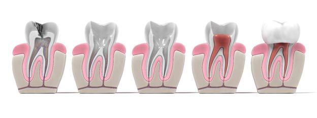 root canals